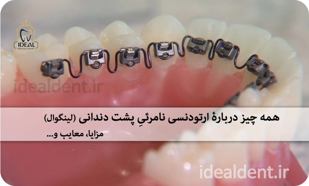 ارتودنسی نامرئی