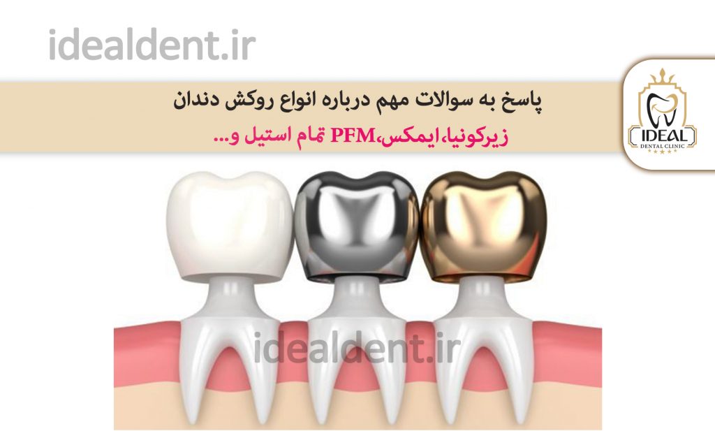 روکش دندان زیرکونیا یا pfm