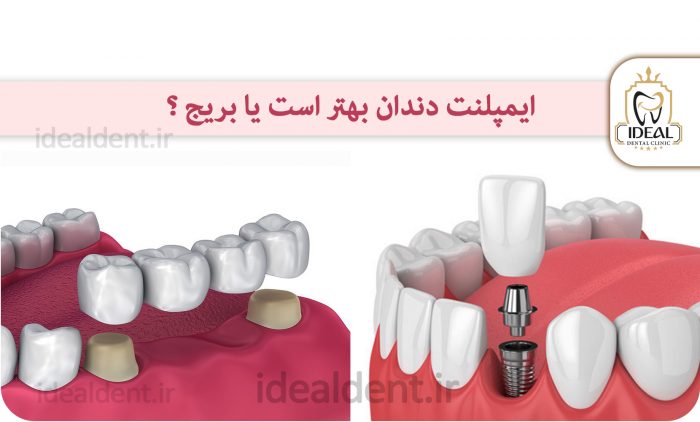 بریج دندان یا ایمپلنت دندان