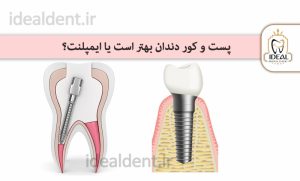 پست و کور دندان یا ایمپلنت